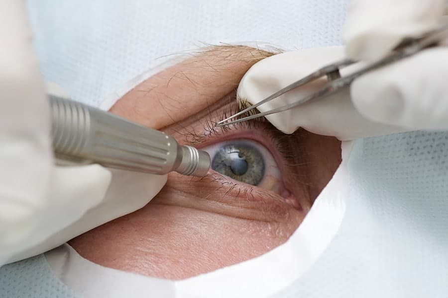 operation cataracte ultrason ophtalmologiste specialiste chirurgie cataracte paris dr camille rambaud