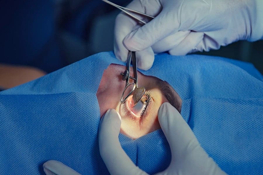 operation de la cataracte déroulement ophtalmo specialiste chirurgie cataracte paris docteur camille rambaud