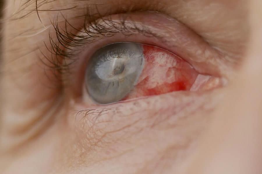 precautions apres operation cataracte effets secondaires ophtalmologue specialiste chirurgie cataracte paris docteur camille rambaud