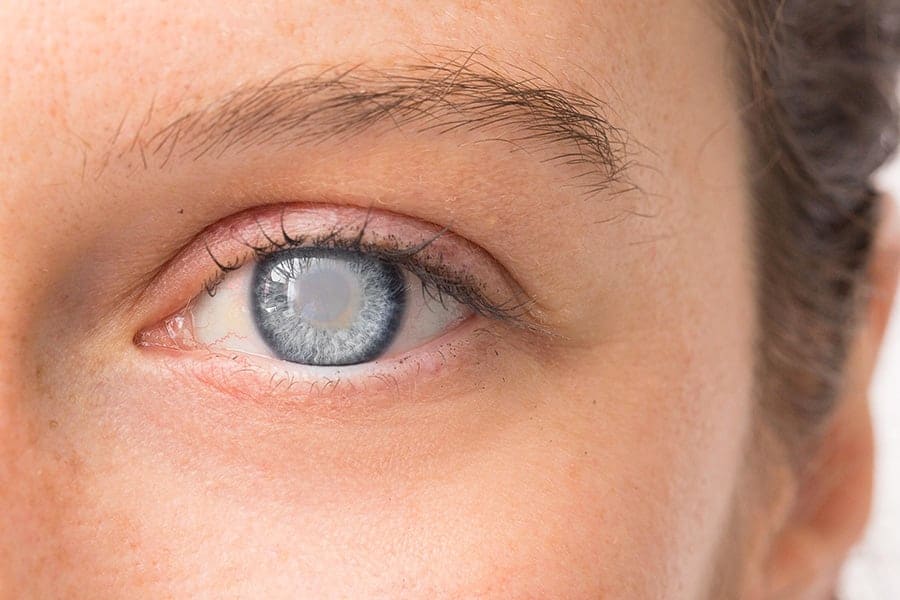 symptome cataracte oeil cataracte precoce ophtalmologiste specialiste chirurgie cataracte paris dr camille rambaud