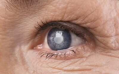 Chirurgie de la cataracte : douleur après 1 mois