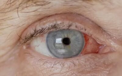 Après une opération de la cataracte : ce qu’il faut savoir