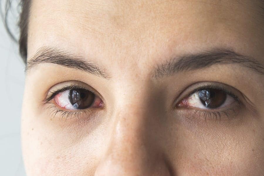 oeil coule apres operation cataracte secheresse oculaire effets secondaires operation cataracte chirurgien ophtalmologue specialiste chirurgie cataracte paris dr camille rambaud