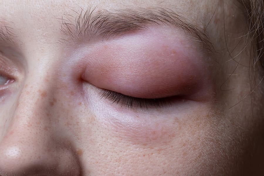 pourquoi oedeme apres operation cataracte oedeme maculaire oeil gonfle complication chirurgien ophtalmologue specialiste chirurgie cataracte paris dr camille rambaud